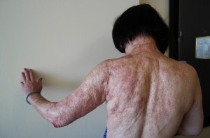 In this Sept. 27, 2015 photo, Kim Phuc shows the burn scars on her back and arms after laser treatments in Miami. Phuc was burned in the back and left arm by a napalm bomb in Vietnam more than 40 years ago. (AP Photo/Nick Ut)